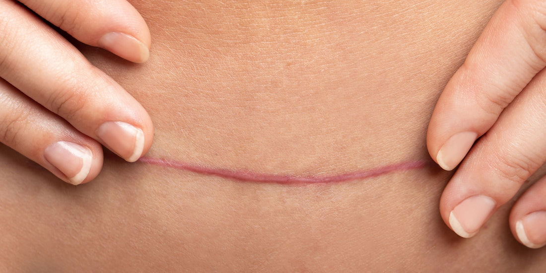 C-Section Scar Care: How to Heal, Fade, and Strengthen Your Postpartum Skin