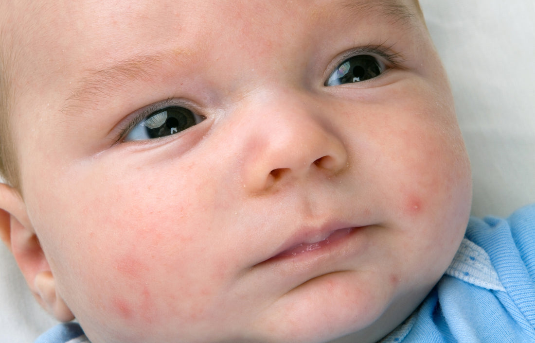 Baby Acne Causes, Prevention and Treatment