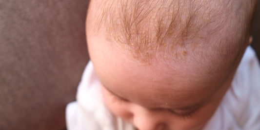 Cradle Cap: Causes, Treatment, and What NOT to Do