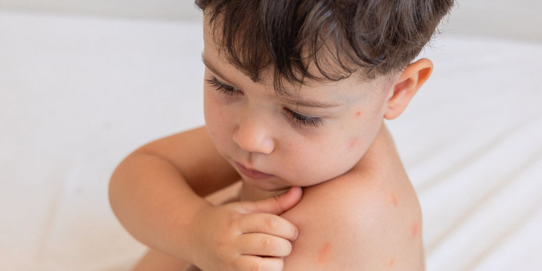 How to Treat Bug Bites on Kids: Itch Relief & Prevention Tips That Work