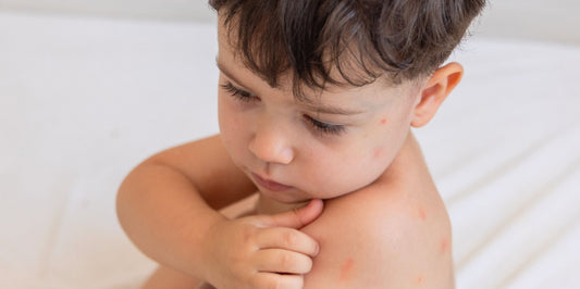 How to Treat Bug Bites on Kids: Itch Relief & Prevention Tips That Work